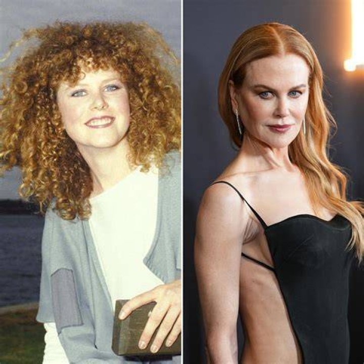 All About Nicole Kidman's Plastic Surgery: Enhancements And Procedures