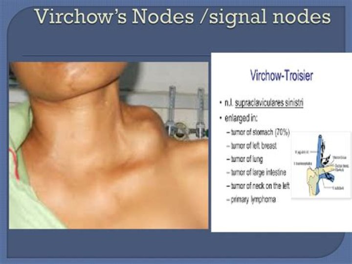 An Overview Of Virchow's Node: Causes And Significance