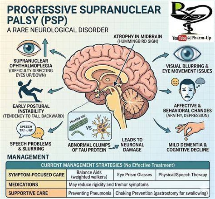 Billy Miller's Fight Against Progressive Supranuclear Palsy