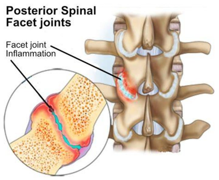 Discover Advanced Facet Arthrosis Treatment Options For Lasting Relief