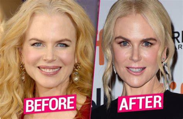 Dr Nicole Kidman's Facelift - Did She Get It?