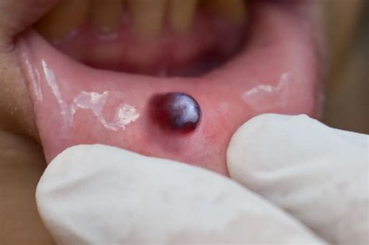 Emergency Relief: Heal Your Painful Blood Blister On The Roof Of Your Mouth