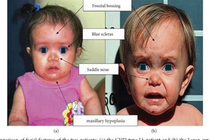 Exploring The Causes And Treatments Of Hasbulla Syndrome