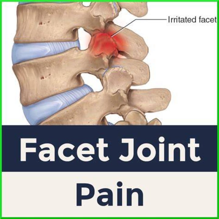 Facet Joint Arthropathy Sports Medicine Review