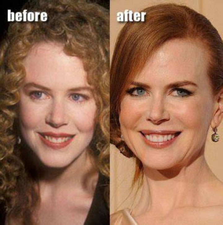 Has Nicole Kidman Had Breast Augmentation? Surgery Scrutiny And Truths