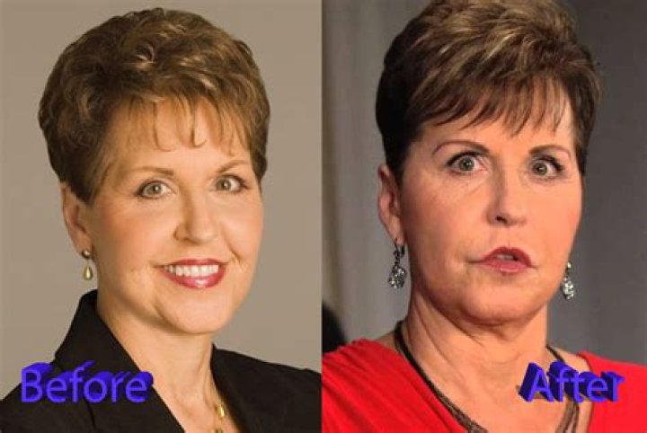 Is Joyce Meyer Hiding A Face Surgery? Uncovering The Truth