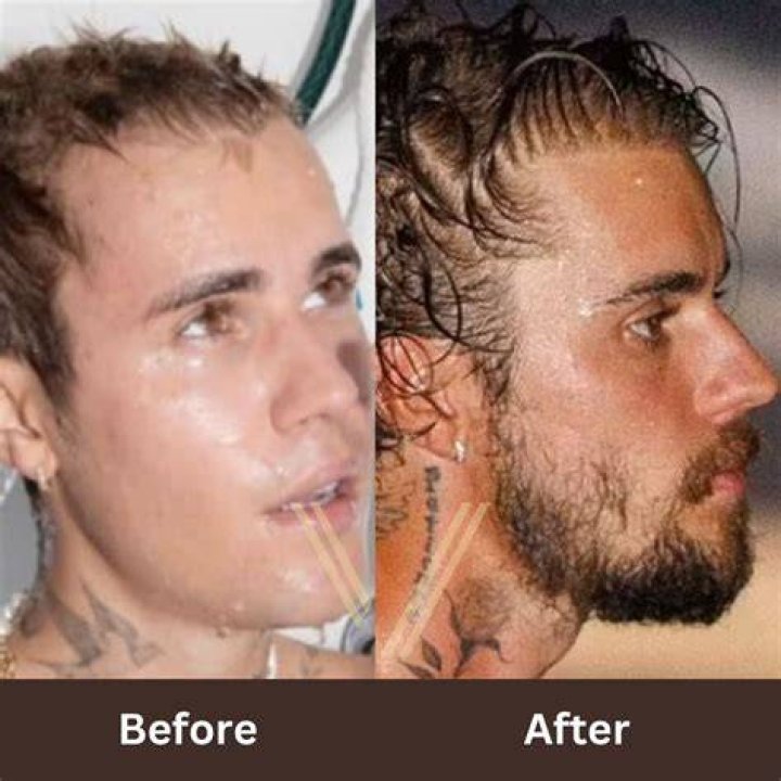 Justin Bieber, Before and After Transformation 2018!