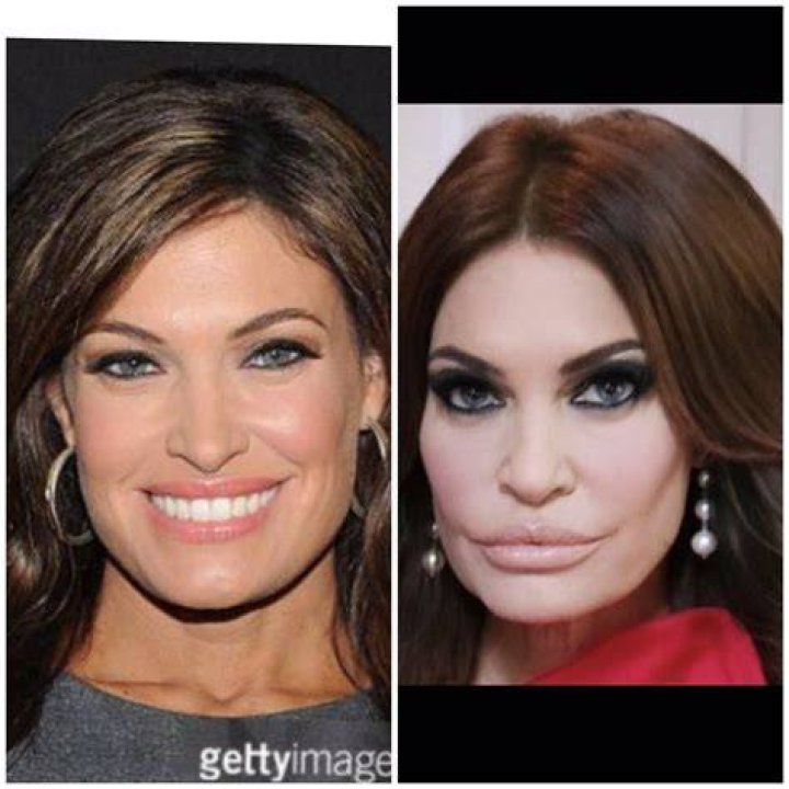 Kimberly Guilfoyle: Before And After Plastic Surgery Transformation
