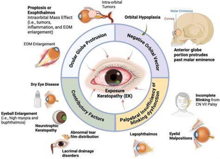 KP Eye: A Complete Guide To Keratopathy Prognosis