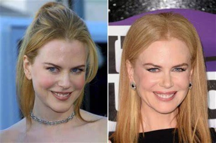 Nicole Kidman's Plastic Surgery Journey: Unveiling The Truth