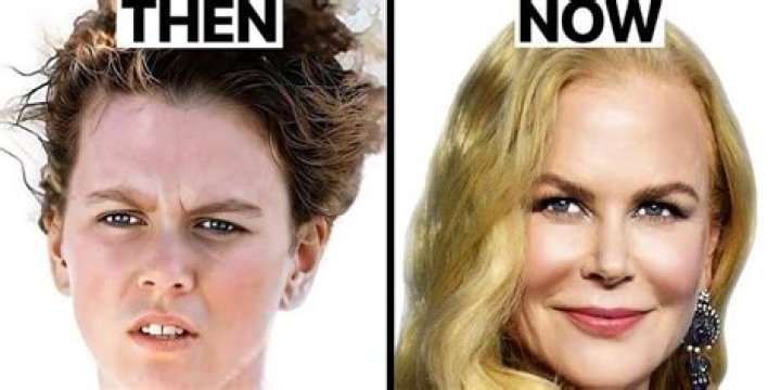 Nicole Kidman Breast Implants Plastic Surgery Before and After Celebie