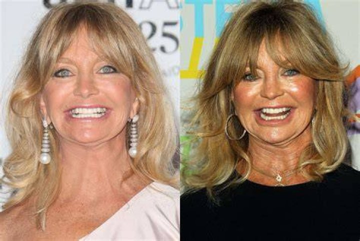 Plastic Surgery Speculations: Examining Goldie Hawn's Transformation