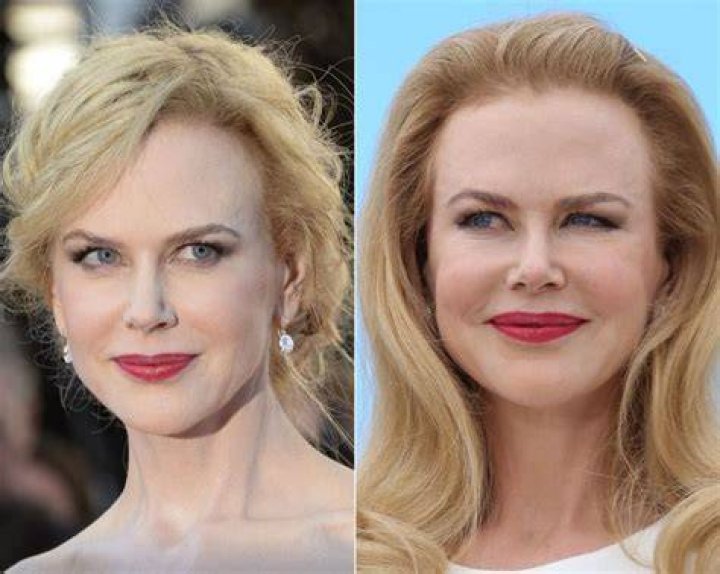 The Evolution Of Nicole Kidman: Before And After Plastic Surgery