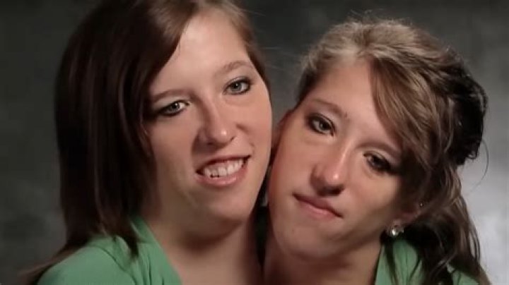 The Tragic Death Of Conjoined Twins Abby And Brittany Hensel