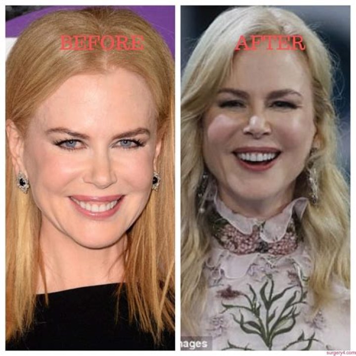 The Truth About Nicole Kidman's Plastic Surgery Speculations