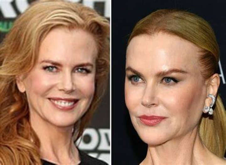 The Truth Behind Nicole Kidman's Plastic Surgery: Fact Or Fiction?