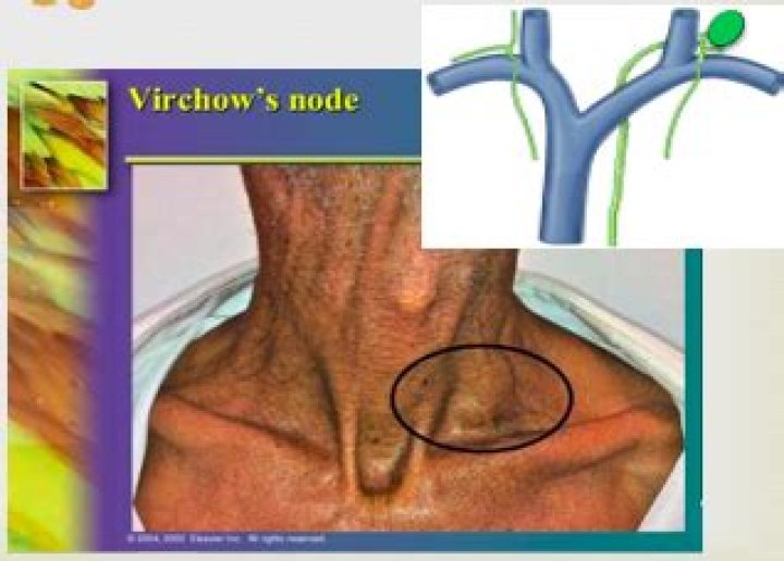 The Truth: Is Virchow's Node Always Cancerous?