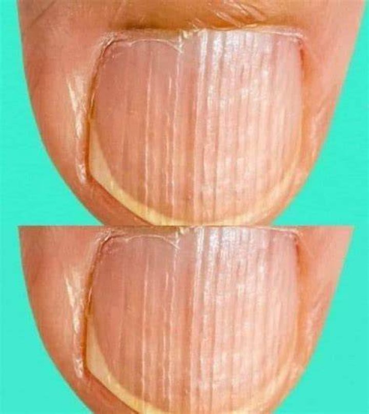 What You Should Know About Fingernails With Horizontal Ridges