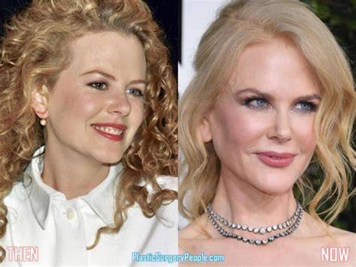 Woman, 54, Looks Like Nicole Kidman After Getting Surgery
